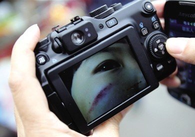 4岁女童脸部有明显伤痕。昨天，该女童称因吃饭慢被老师掐伤。园方表示将开除涉事老师。新京报记者 王贵彬 摄